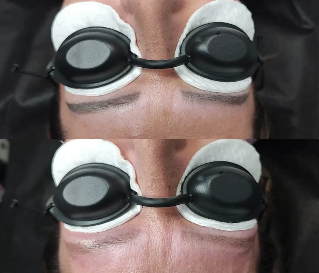 laserowe usuwanie makijażu permanentnego